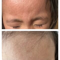 アレルギーを持つ子が増えた