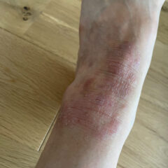 アトピーに悩まされている