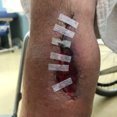 傷口にもえいち※閲覧注意