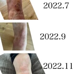 掻いちゃダメ！　搔かなきゃいいじゃん！