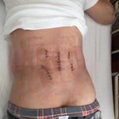 セカンドオピニオン