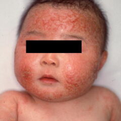 アトピーの悩み　慧一の水