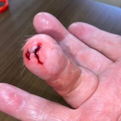 傷　火傷　虫刺され　えいちの水