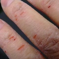 アカギレ　ヒビ　割れる　慧一之水で解決