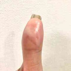 火傷は痛いはずだよね？！　慧一之水